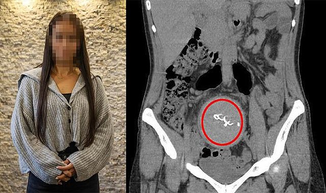 Özel hastanede skandal! Doğum sırasında oldu, 2 yıl sonra fark edildi