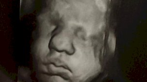 ABD'deki çift rahimli kadın aynı anda iki farklı bebeğe hamile kaldı