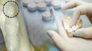 Çekilen, çürüyen dişi yeniden çıkarttı! Bu ilacın tek dozu bile yetiyor