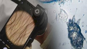 Geceleri artan kaşıntı en önemli belirti! Bu şikayetleriniz varsa dikkat