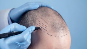 Uzmanlar uyardı: Saç ektirecekler, kliniğin ruhsatını kontrol etsin