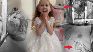 Minik kalbini 'söküp' tekrar yerleştirdiler! 'Soğan kabuğu soyar gibi ayırdık'