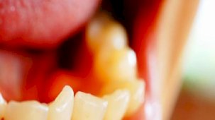 Diş travmaları: Acil durumlarda doğru müdahale