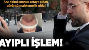 Saç ekimi sonrası ortaya çıkan görüntü mahkemede bitti: Ayıplı işlem
