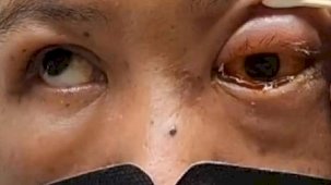 Tayvan'da şaşırtan olay: Sarhoşken yüzüstü uyuyan adam kör uyandı