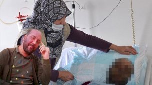 Yağmur ormanlarında yaşayanlarda görülen hastalık! Koronavirüs geçirdikten 1 sene sonra yüzü tanınmaz hale geldi