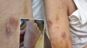 Zihinsel engelli öğrenciye öğretmen şiddeti: İşkence görmüş, dayak değil