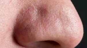 Burun ağrısı şikayeti ile hastaneye giden adamın burnundan 150 böcek çıktı