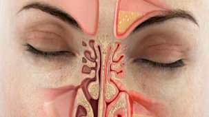 Şişen burun etlerini küçültüyor; Günde 1 bardak kafi...