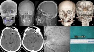 Bursa'da beynine saplanan implant hayatını kararttı