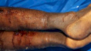 İsrail’in iade ettiği cenazelerde işkence izleri görüldü