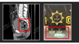 Tomografide şok eden görüntü...Uyuşturucu midesinden çıkarıldı