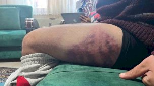 Vicdanları yaralayan olay: Otizmli şahıs odunluğa baktı diye odunla darbedildi