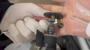 Batman’da parmağa sıkışan iki yüzük ’spiral makine’ ile çıkarıldı